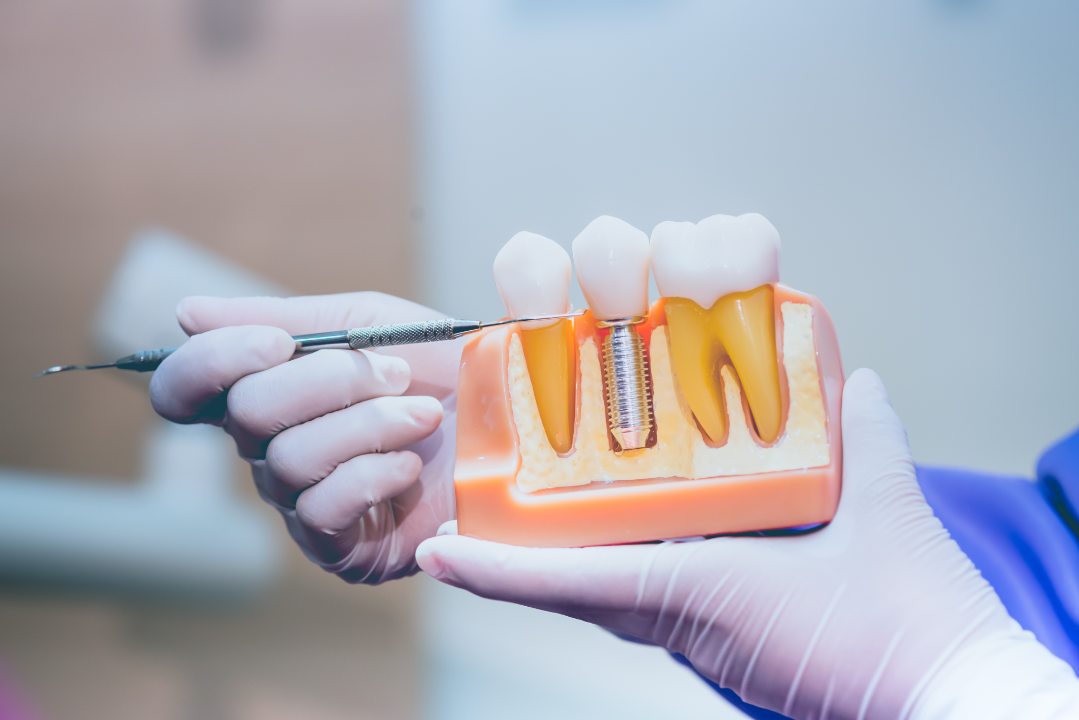 Gloved hands holding a dental model showing natural teeth and a dental implant with an attached crown, while pointing with a dental tool.